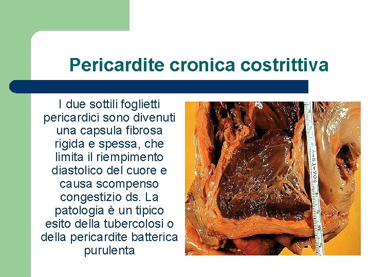 Pericardite cronica costrittiva I due sottili foglietti pericardici sono divenuti una capsula fibrosa rigida