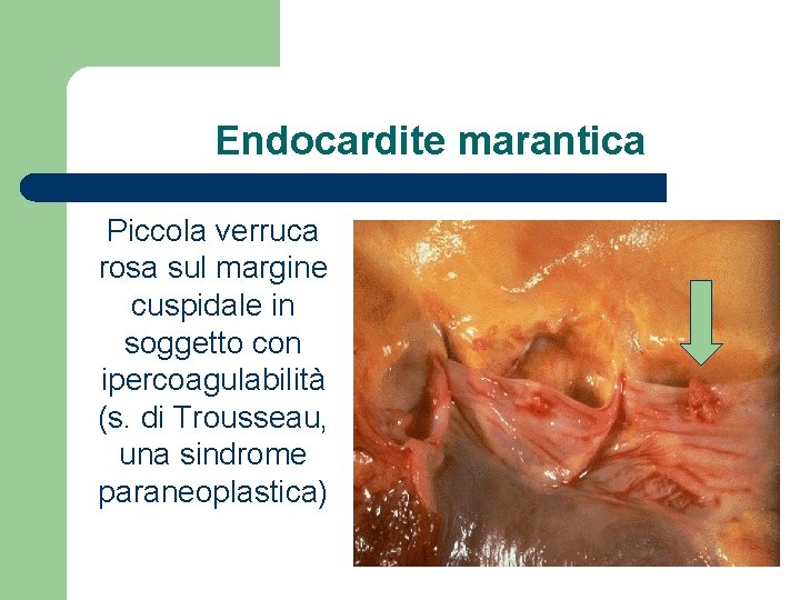 Endocardite marantica Piccola verruca rosa sul margine cuspidale in soggetto con ipercoagulabilità (s. di
