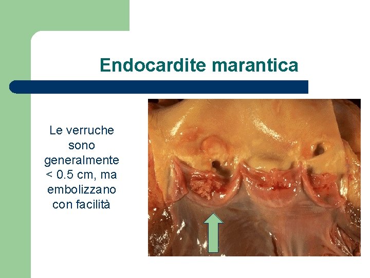 Endocardite marantica Le verruche sono generalmente < 0. 5 cm, ma embolizzano con facilità