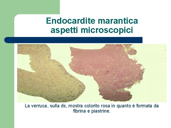 Endocardite marantica aspetti microscopici La verruca, sulla ds, mostra colorito rosa in quanto è