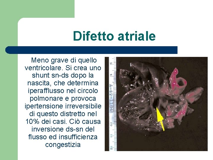 Difetto atriale Meno grave di quello ventricolare. Si crea uno shunt sn-ds dopo la