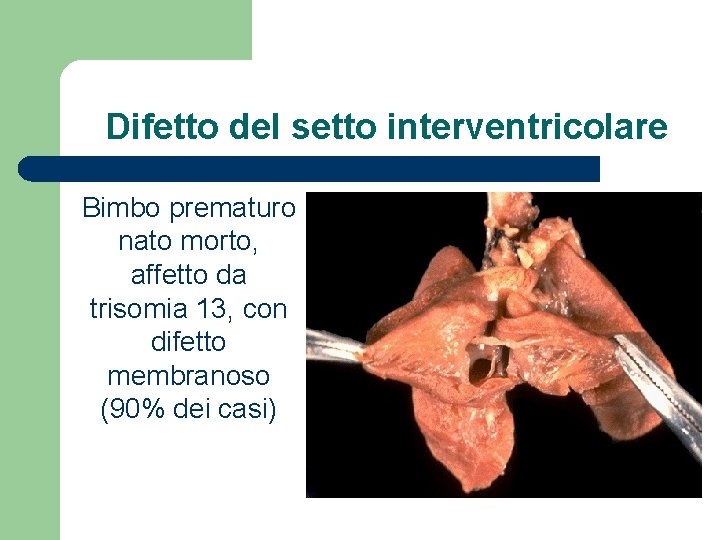 Difetto del setto interventricolare Bimbo prematuro nato morto, affetto da trisomia 13, con difetto