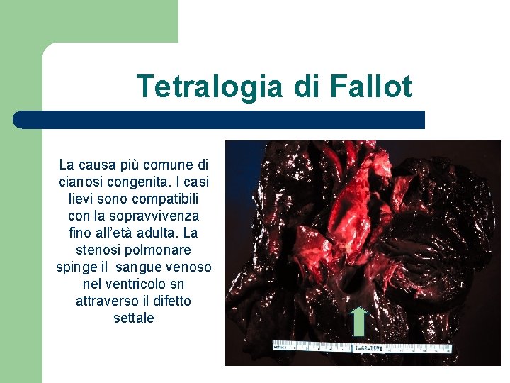 Tetralogia di Fallot La causa più comune di cianosi congenita. I casi lievi sono