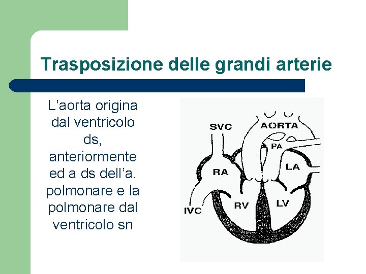 Trasposizione delle grandi arterie L’aorta origina dal ventricolo ds, anteriormente ed a ds dell’a.