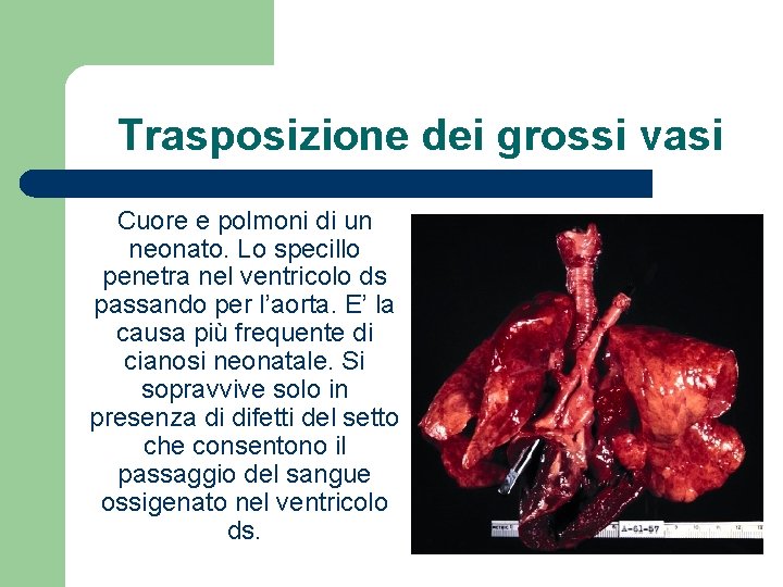 Trasposizione dei grossi vasi Cuore e polmoni di un neonato. Lo specillo penetra nel