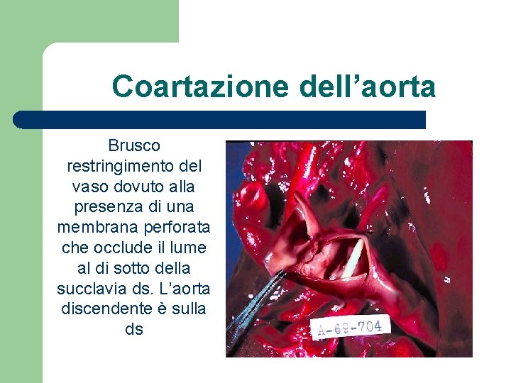 Coartazione dell’aorta Brusco restringimento del vaso dovuto alla presenza di una membrana perforata che