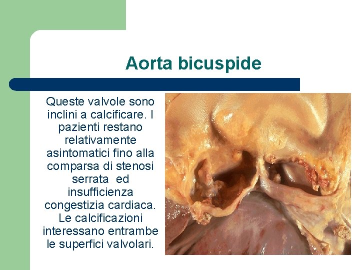 Aorta bicuspide Queste valvole sono inclini a calcificare. I pazienti restano relativamente asintomatici fino