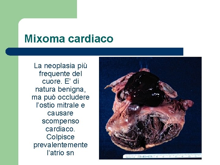 Mixoma cardiaco La neoplasia più frequente del cuore. E’ di natura benigna, ma può