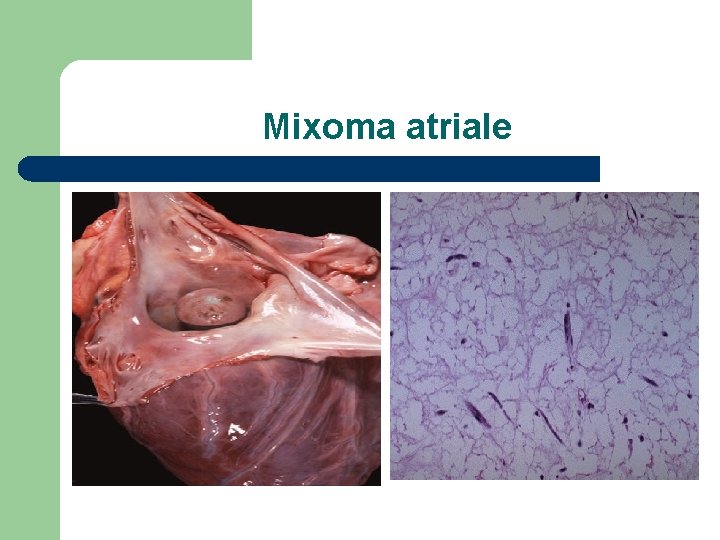 Mixoma atriale 