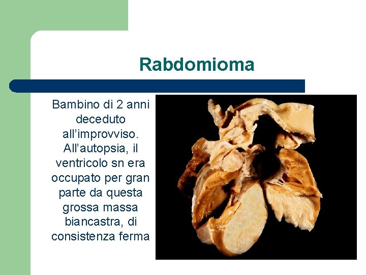 Rabdomioma Bambino di 2 anni deceduto all’improvviso. All’autopsia, il ventricolo sn era occupato per