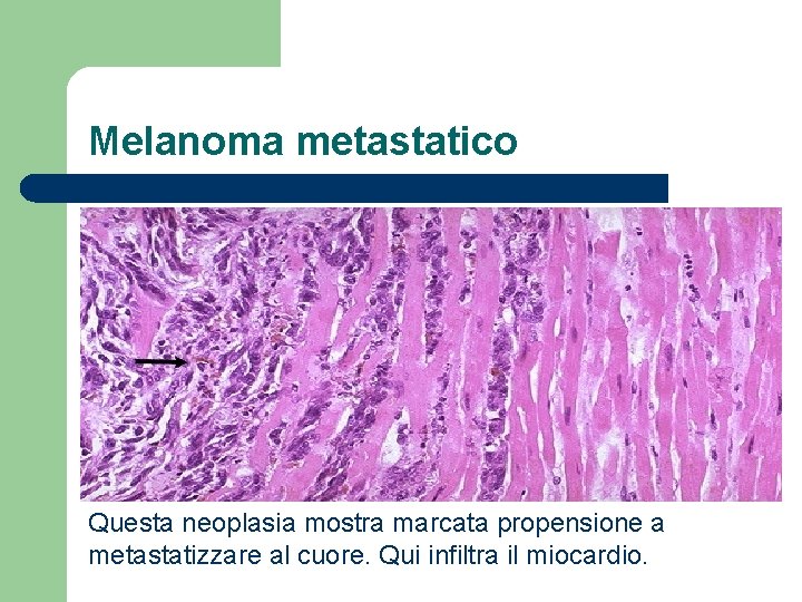 Melanoma metastatico Questa neoplasia mostra marcata propensione a metastatizzare al cuore. Qui infiltra il