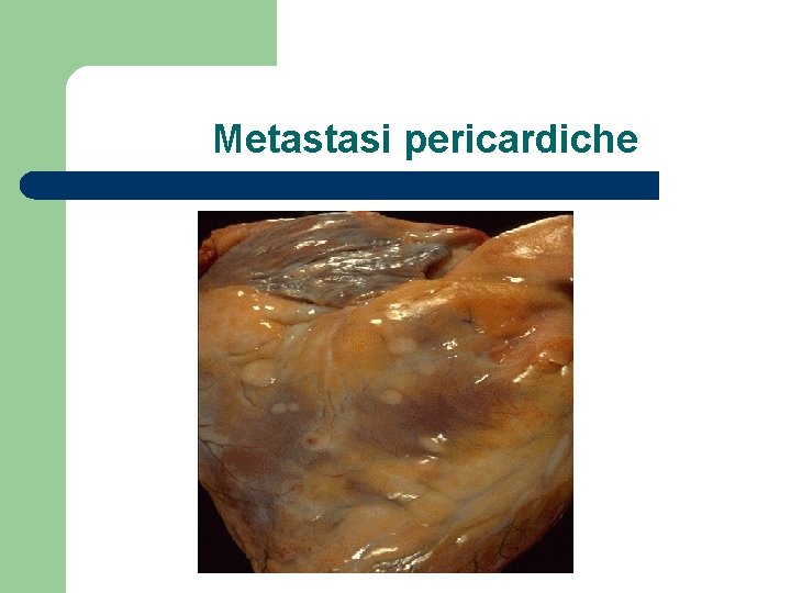 Metastasi pericardiche 