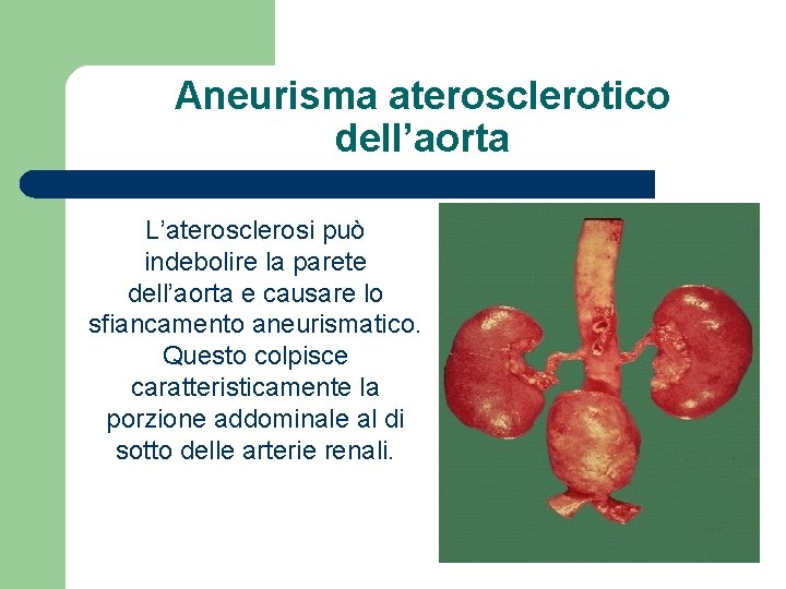 Aneurisma aterosclerotico dell’aorta L’aterosclerosi può indebolire la parete dell’aorta e causare lo sfiancamento aneurismatico.