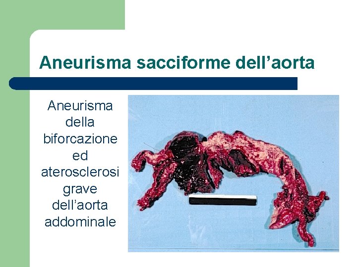 Aneurisma sacciforme dell’aorta Aneurisma della biforcazione ed aterosclerosi grave dell’aorta addominale 