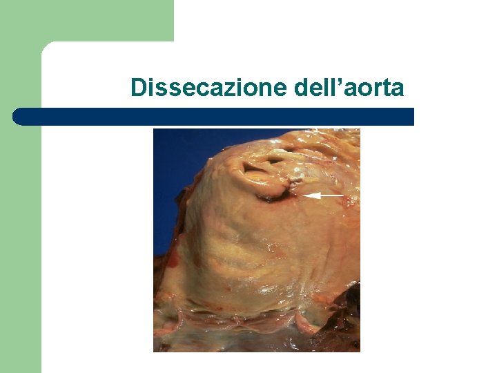 Dissecazione dell’aorta 