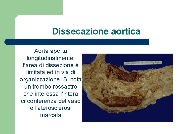 Dissecazione aortica Aorta aperta longitudinalmente: l’area di dissezione è limitata ed in via di