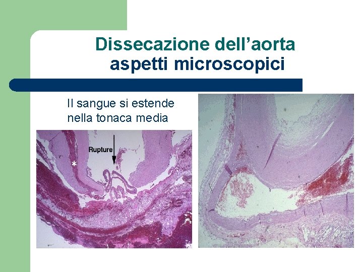 Dissecazione dell’aorta aspetti microscopici Il sangue si estende nella tonaca media 