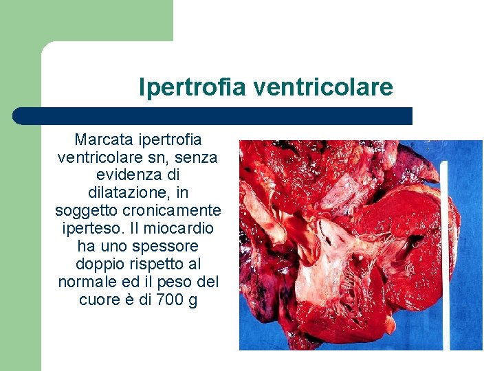 Ipertrofia ventricolare Marcata ipertrofia ventricolare sn, senza evidenza di dilatazione, in soggetto cronicamente iperteso.
