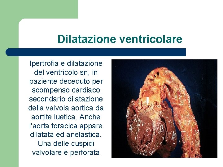 Dilatazione ventricolare Ipertrofia e dilatazione del ventricolo sn, in paziente deceduto per scompenso cardiaco