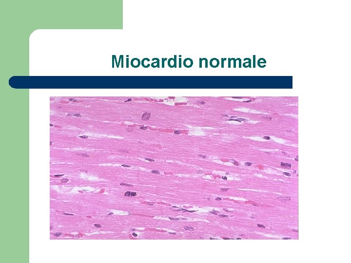 Miocardio normale 