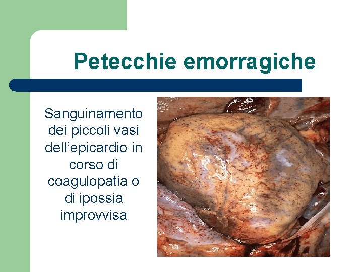 Petecchie emorragiche Sanguinamento dei piccoli vasi dell’epicardio in corso di coagulopatia o di ipossia