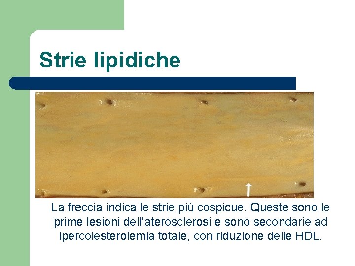 Strie lipidiche La freccia indica le strie più cospicue. Queste sono le prime lesioni