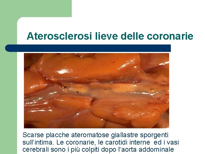 Aterosclerosi lieve delle coronarie Scarse placche ateromatose giallastre sporgenti sull’intima. Le coronarie, le carotidi