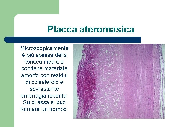 Placca ateromasica Microscopicamente è più spessa della tonaca media e contiene materiale amorfo con