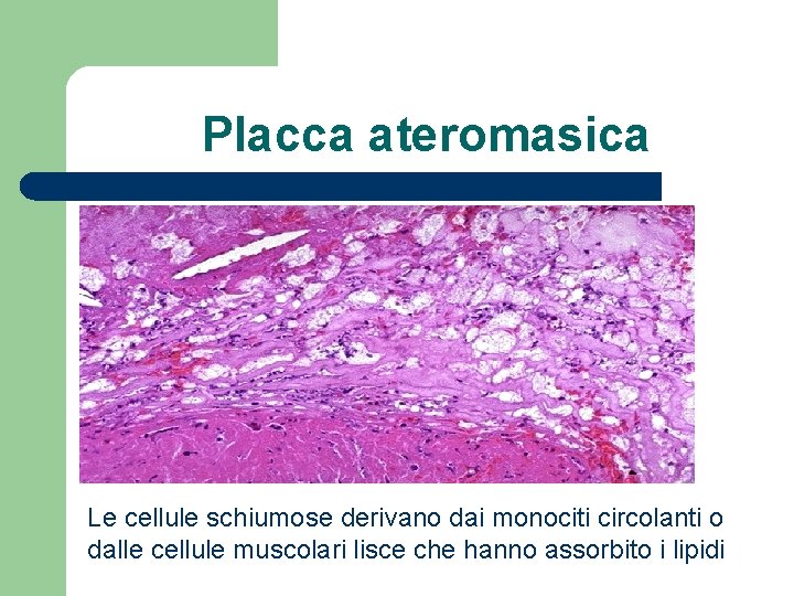 Placca ateromasica Le cellule schiumose derivano dai monociti circolanti o dalle cellule muscolari lisce