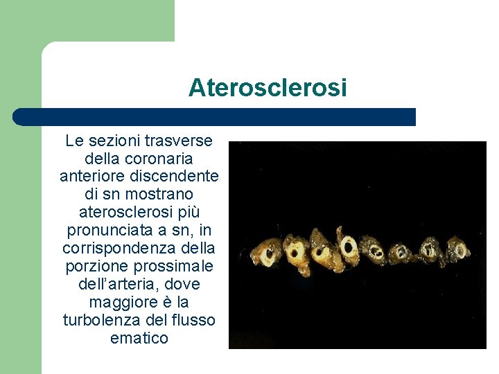 Aterosclerosi Le sezioni trasverse della coronaria anteriore discendente di sn mostrano aterosclerosi più pronunciata