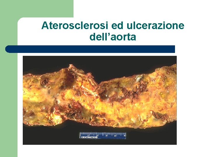 Aterosclerosi ed ulcerazione dell’aorta 