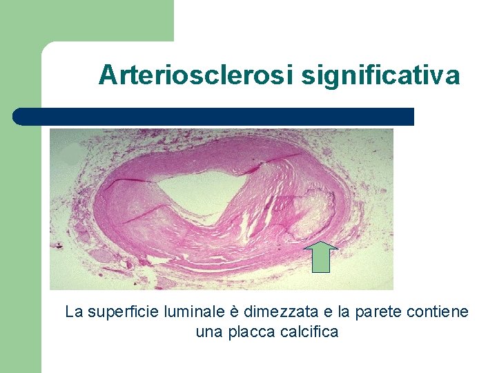 Arteriosclerosi significativa La superficie luminale è dimezzata e la parete contiene una placca calcifica