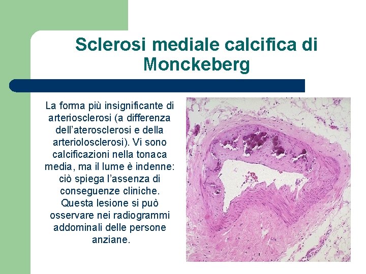 Sclerosi mediale calcifica di Monckeberg La forma più insignificante di arteriosclerosi (a differenza dell’aterosclerosi