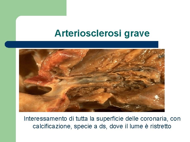 Arteriosclerosi grave Interessamento di tutta la superficie delle coronaria, con calcificazione, specie a ds,