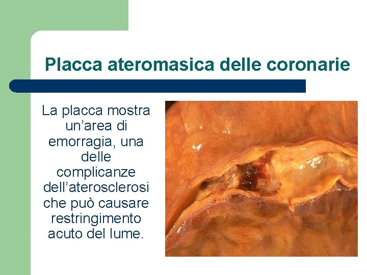 Placca ateromasica delle coronarie La placca mostra un’area di emorragia, una delle complicanze dell’aterosclerosi