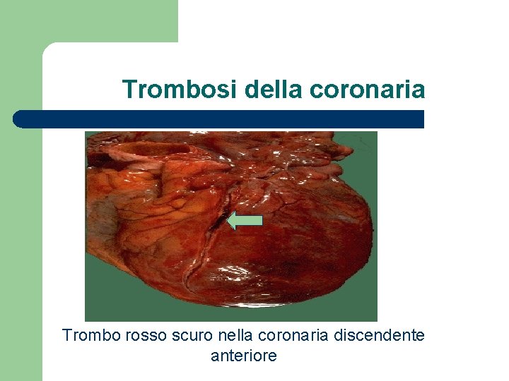 Trombosi della coronaria Trombo rosso scuro nella coronaria discendente anteriore 