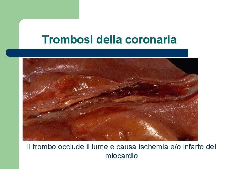 Trombosi della coronaria Il trombo occlude il lume e causa ischemia e/o infarto del