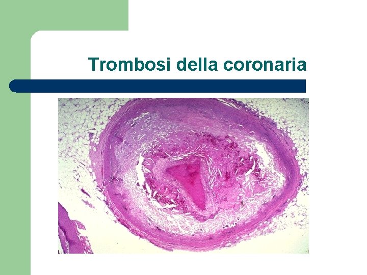 Trombosi della coronaria 