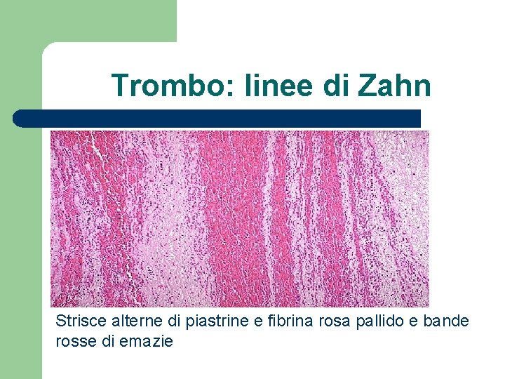 Trombo: linee di Zahn Strisce alterne di piastrine e fibrina rosa pallido e bande