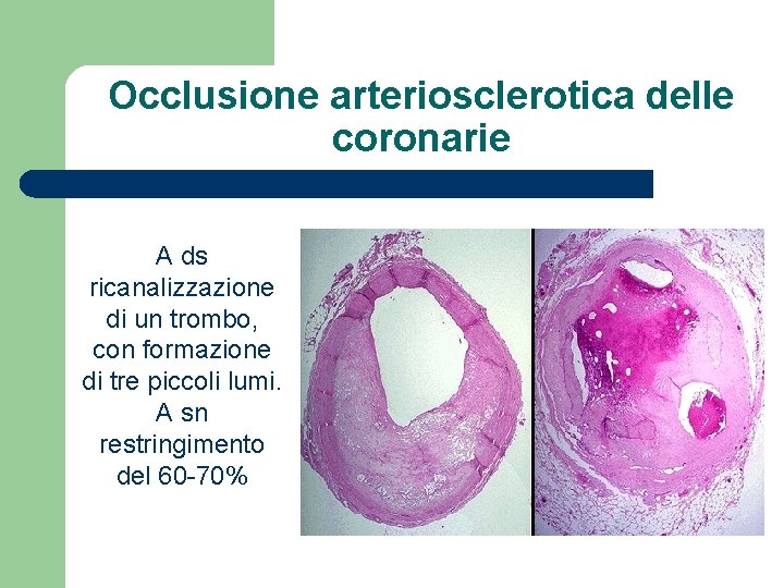 Occlusione arteriosclerotica delle coronarie A ds ricanalizzazione di un trombo, con formazione di tre