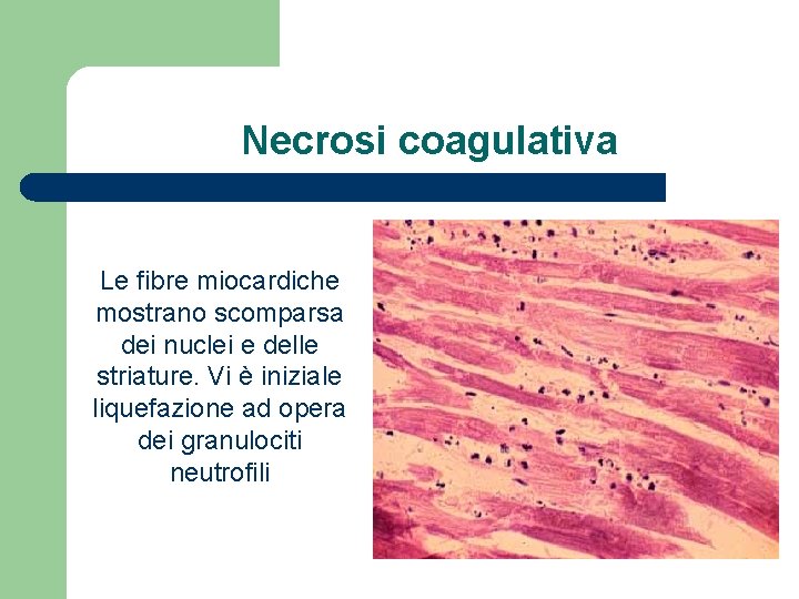 Necrosi coagulativa Le fibre miocardiche mostrano scomparsa dei nuclei e delle striature. Vi è
