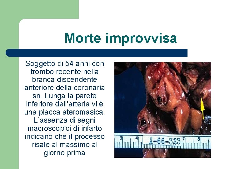 Morte improvvisa Soggetto di 54 anni con trombo recente nella branca discendente anteriore della