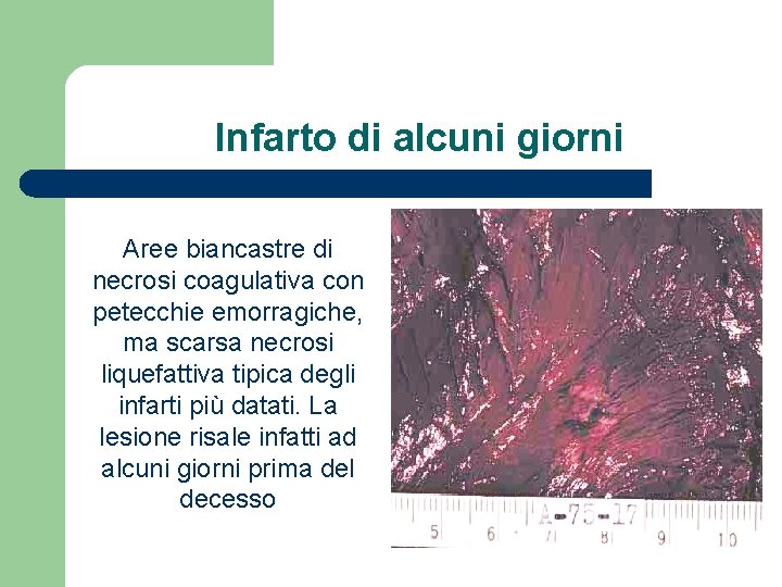 Infarto di alcuni giorni Aree biancastre di necrosi coagulativa con petecchie emorragiche, ma scarsa