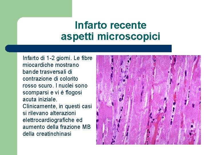 Infarto recente aspetti microscopici Infarto di 1 -2 giorni. Le fibre miocardiche mostrano bande