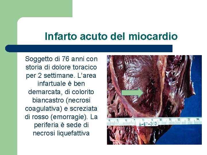 Infarto acuto del miocardio Soggetto di 76 anni con storia di dolore toracico per