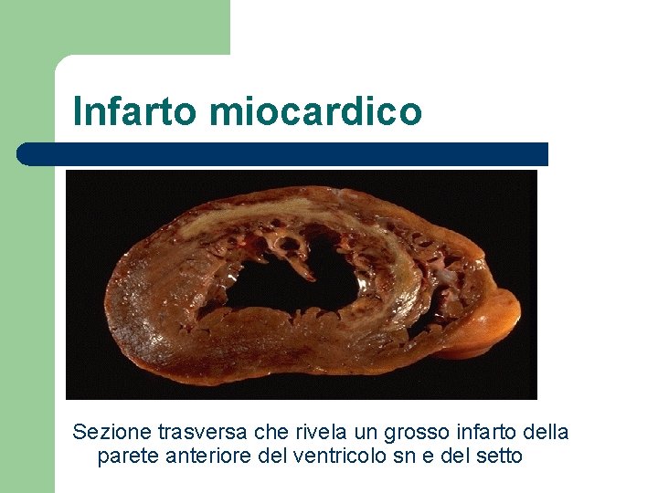 Infarto miocardico Sezione trasversa che rivela un grosso infarto della parete anteriore del ventricolo