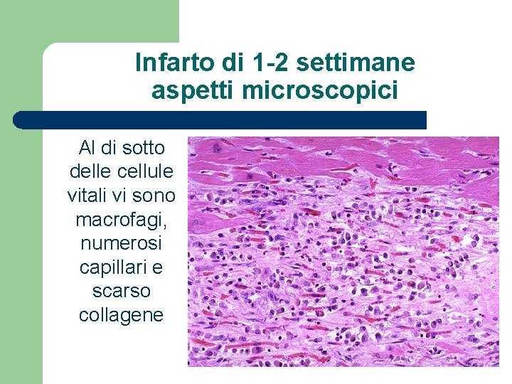 Infarto di 1 -2 settimane aspetti microscopici Al di sotto delle cellule vitali vi