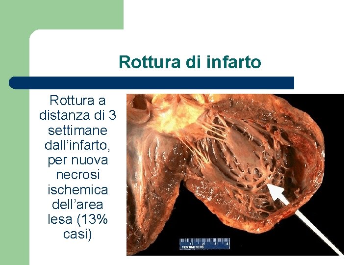 Rottura di infarto Rottura a distanza di 3 settimane dall’infarto, per nuova necrosi ischemica