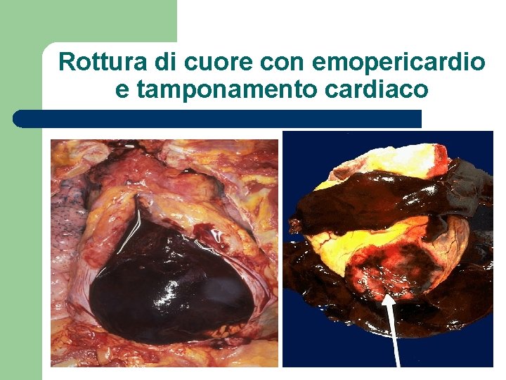 Rottura di cuore con emopericardio e tamponamento cardiaco 