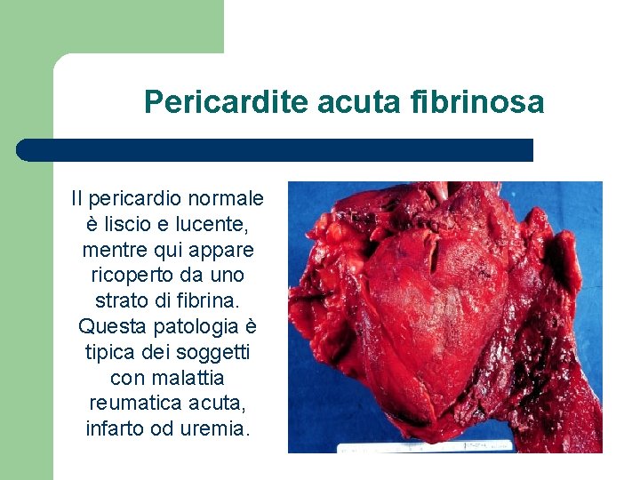 Pericardite acuta fibrinosa Il pericardio normale è liscio e lucente, mentre qui appare ricoperto